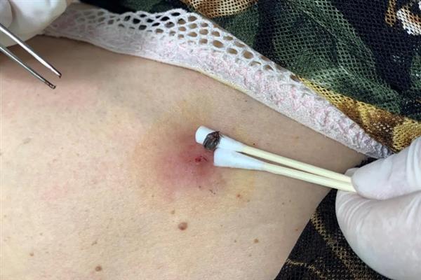 蜱虫的天敌是什么，其天敌是寄生蜂