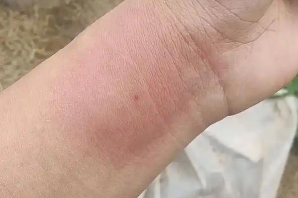 虎头蜂蛰了会中毒吗，会引起红肿、心律失常等