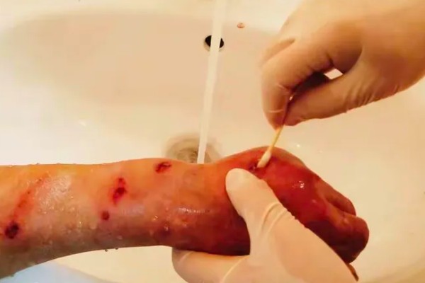 被蜜蜂蛰了如何解决，拔出毒刺再用肥皂水清洗伤口