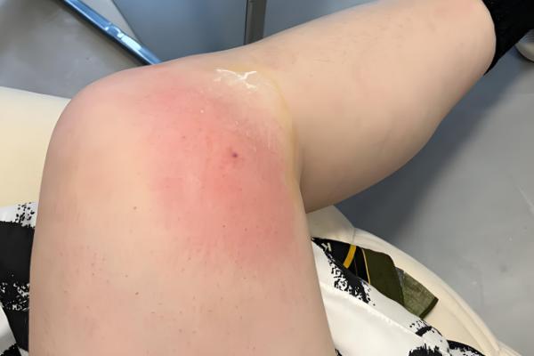 被地雷蜂子蛰了怎么办,及时用食醋等弱酸性溶液清洗伤口