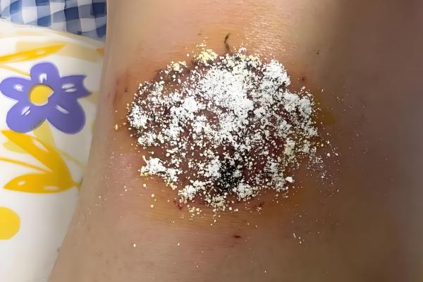 被地雷蜂子蛰了怎么办,及时用食醋等弱酸性溶液清洗伤口