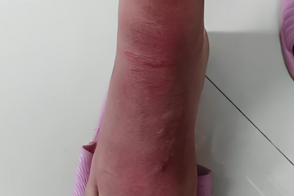 被地雷蜂子蛰了怎么办,及时用食醋等弱酸性溶液清洗伤口