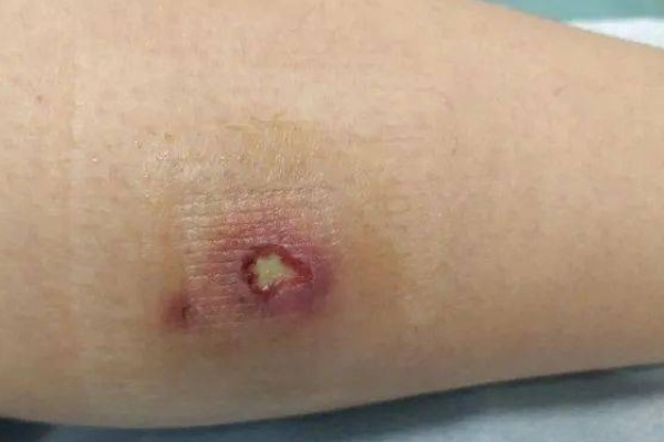 被仙人掌扎了怎么处理，需要先把刺挑出来