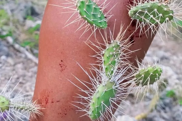 被仙人掌扎了怎么处理，需要先把刺挑出来