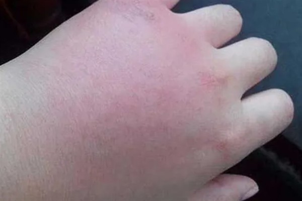 牛角蜂蛰了几天消肿，因蛰伤程度不同而不同