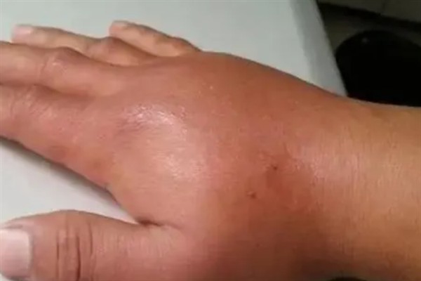 牛角蜂蛰了几天消肿，因蛰伤程度不同而不同